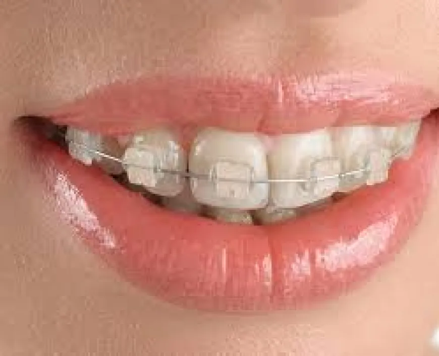 What Are the Different Types of Transparent Braces Available in Dubai?