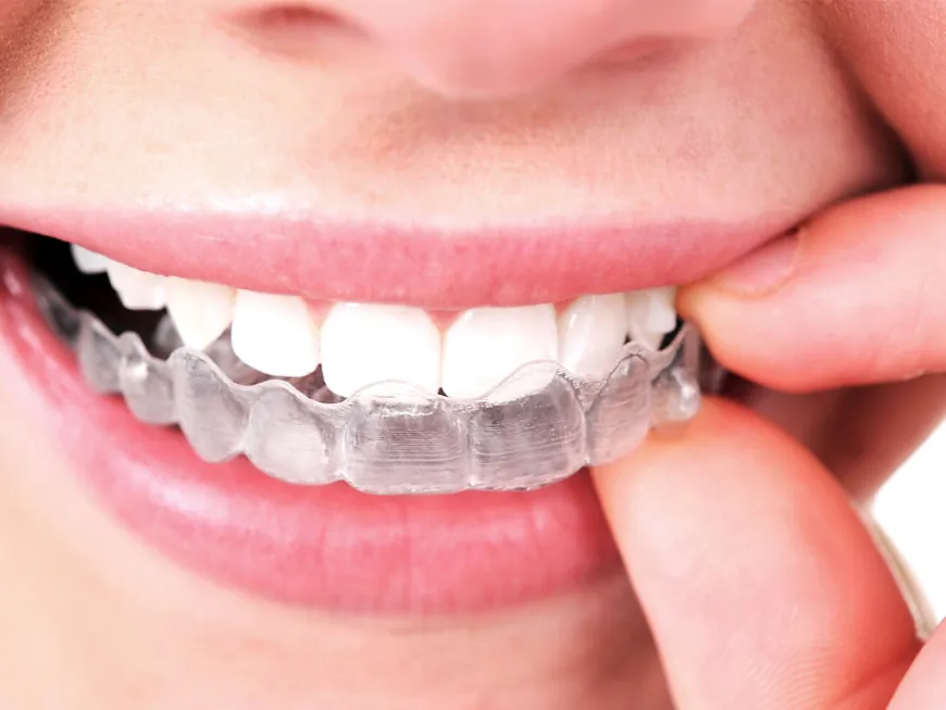 The Complete Breakdown of Invisalign Braces Costs in Dubai