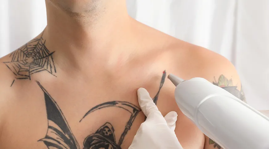 How Tattoos Respond to Laser Removal Over Time: Dubai Case Studies