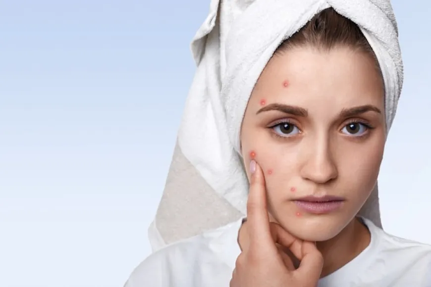 How to Achieve Clear Skin: Acne Treatment Unveiled