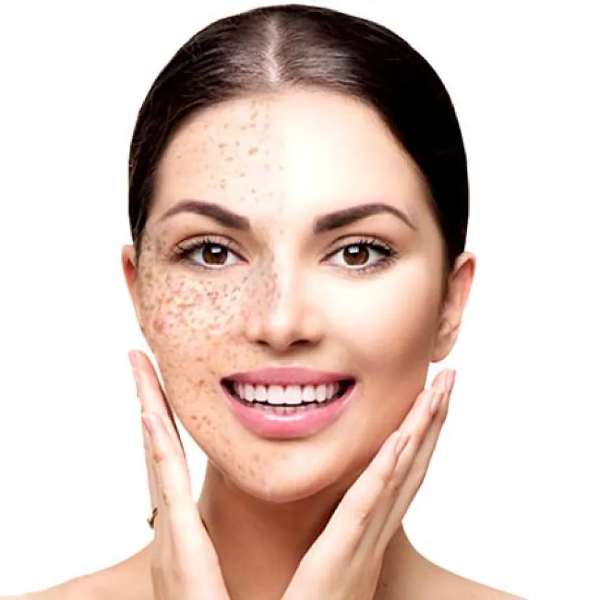 What is the best remover for melasma Treatment?