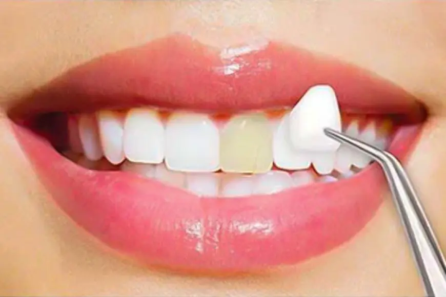 Is the Pain Worth the Gain? Truth About Dental Veneer Procedures