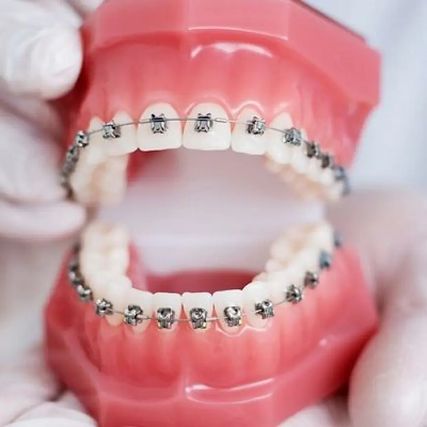 Affordable Dental Braces in Dubai: How to Save While Perfecting Your Smile