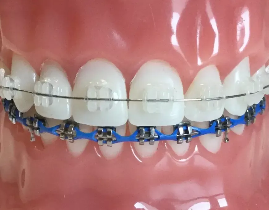 Essential Considerations When Picking Teeth Braces