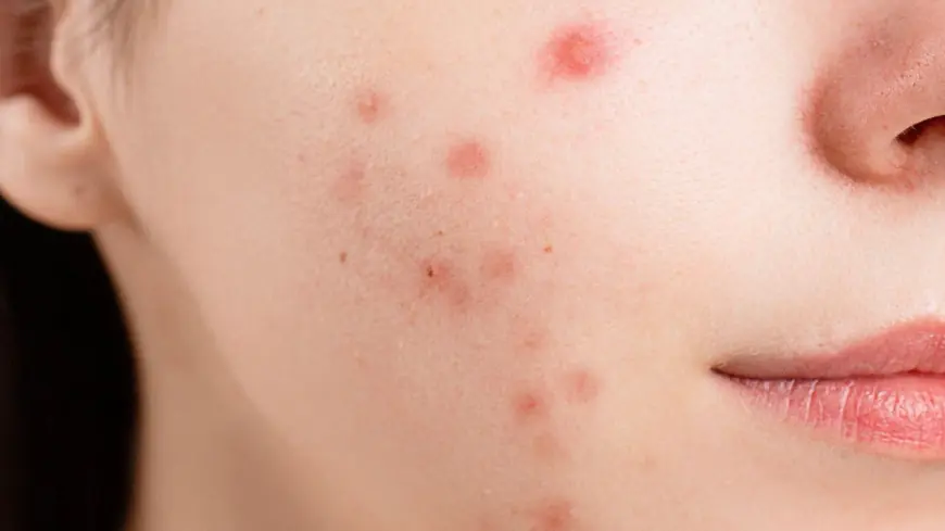 Achieve Flawless Skin: Acne Treatment Tips You Need to Know