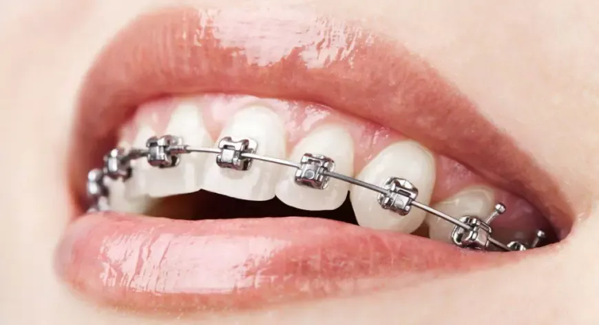 Straighten Your Smile with Ease: Braces Options in Dubai