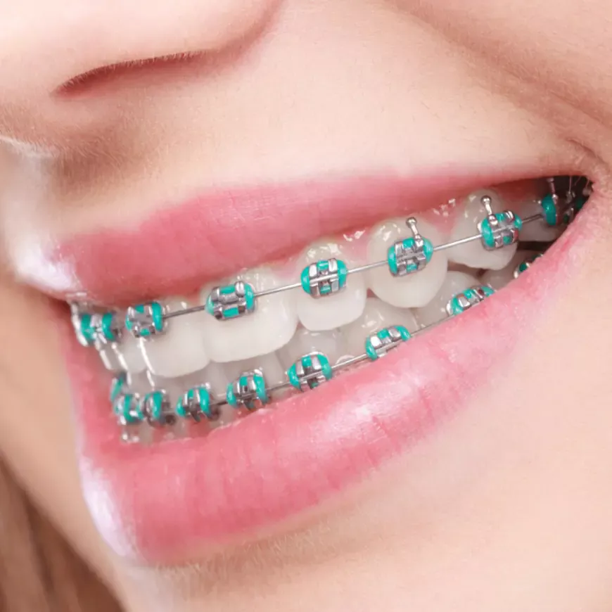 Is It Time for Dental Braces in Dubai? Signs You Should Consider Them