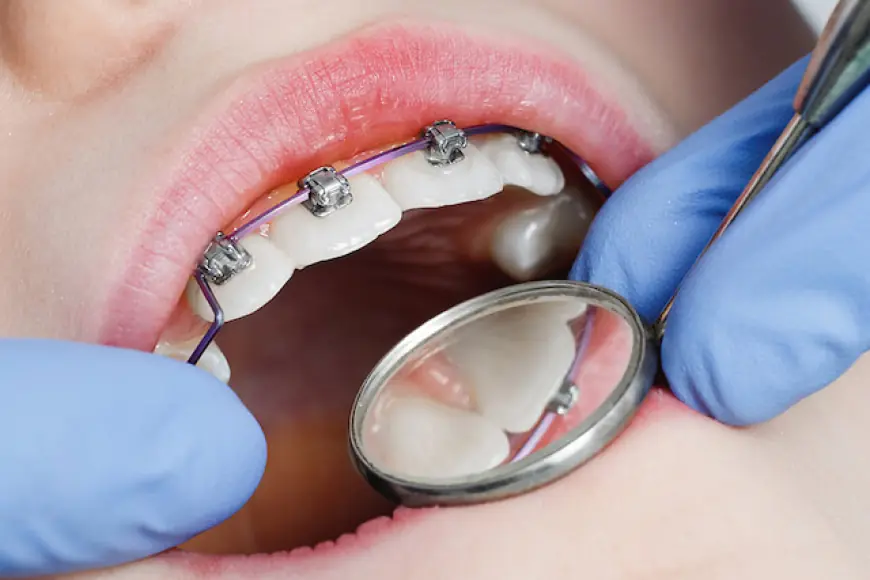 How Long Does It Take to Get Results with Teeth Braces?