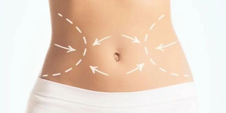 Essential Tips for Maintaining Your Shape After Liposuction in Dubai