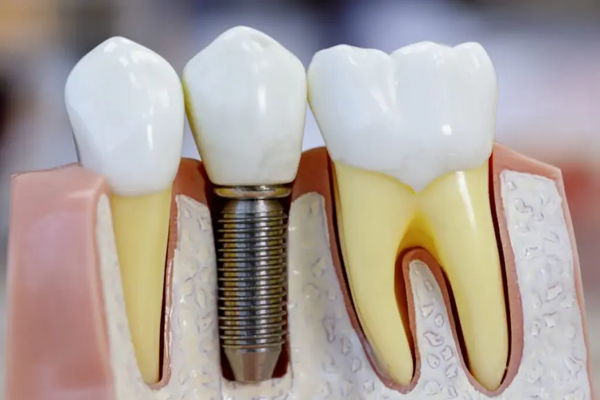 Dental Implants: A Life-Changing Solution for a Better Smile