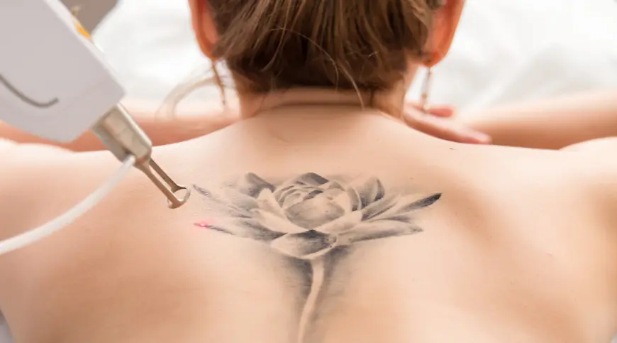 How Safe is Laser Tattoo Removal in Dubai’s Hot Climate?