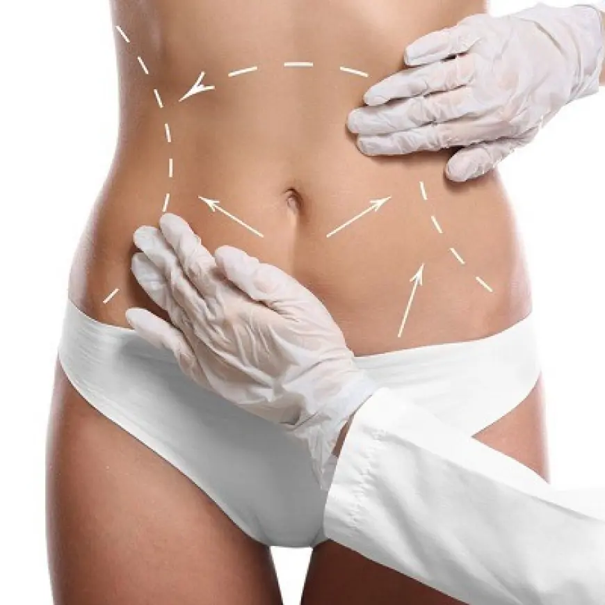 The Best Times to Consider Liposuction for Your Health in Dubai