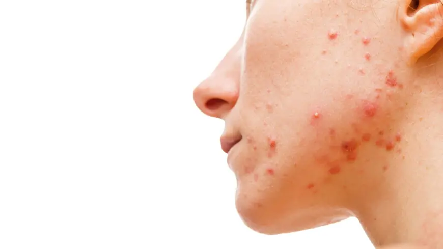 Acne Solutions Unveiled: Your Path to Clear, Healthy Skin