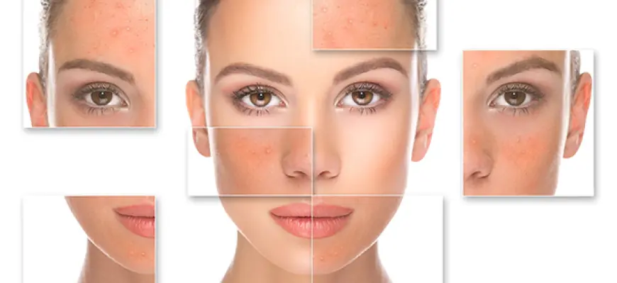 Acne Treatment Selection in Dubai: How to Make the Right Choice