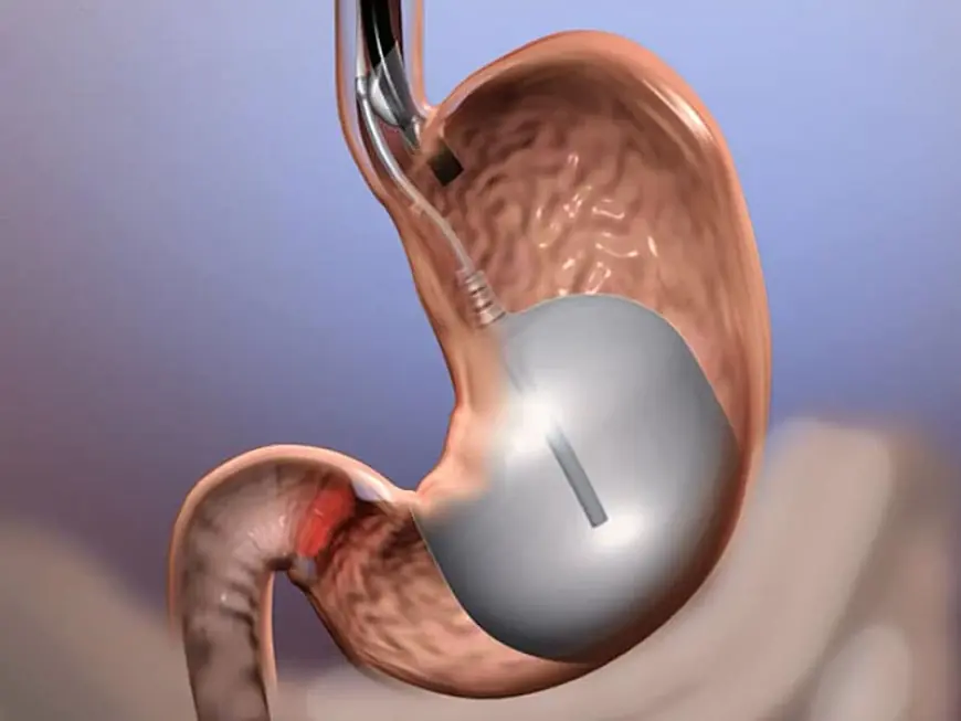 How Long Does Gastric Balloon Placement Last, and What Are the Maintenance Tips in Dubai?