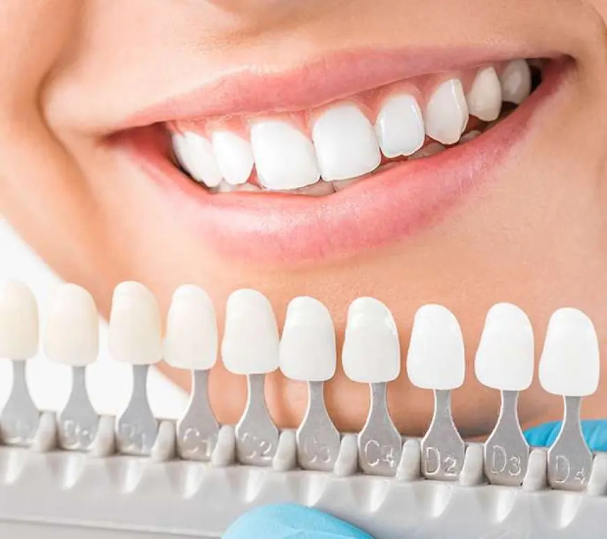 Everything You Need to Know About Front Teeth Crowns for Lasting Results