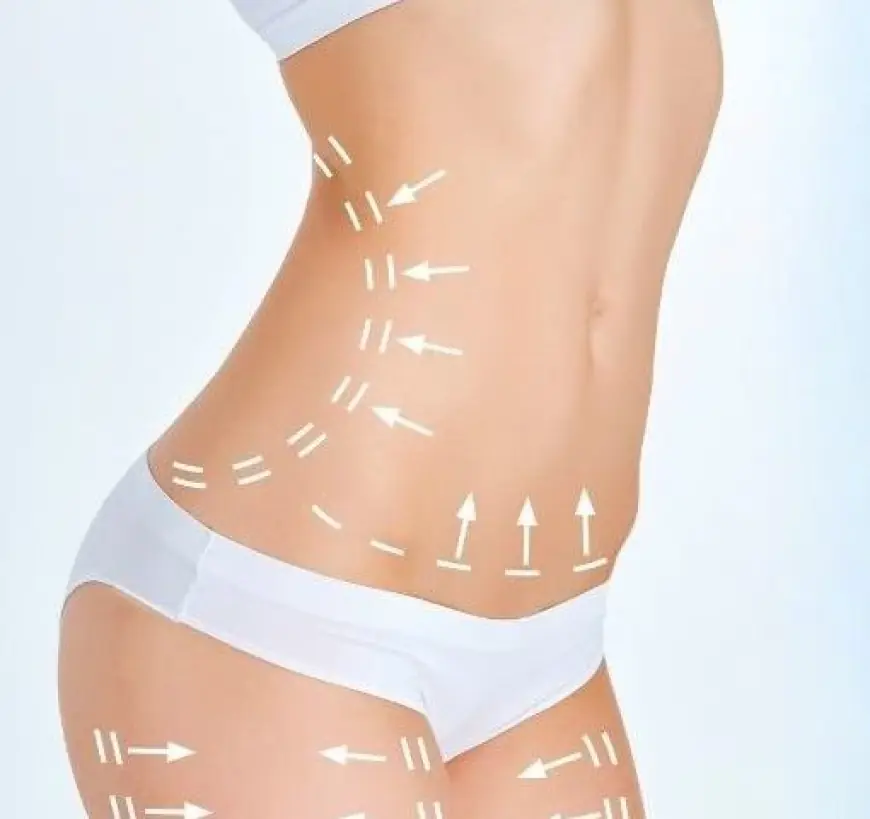 Liposuction Explained: Assessing Its Suitability for You