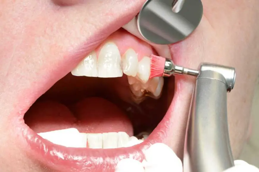 Preventing Cavities: The Role of Teeth Cleaning