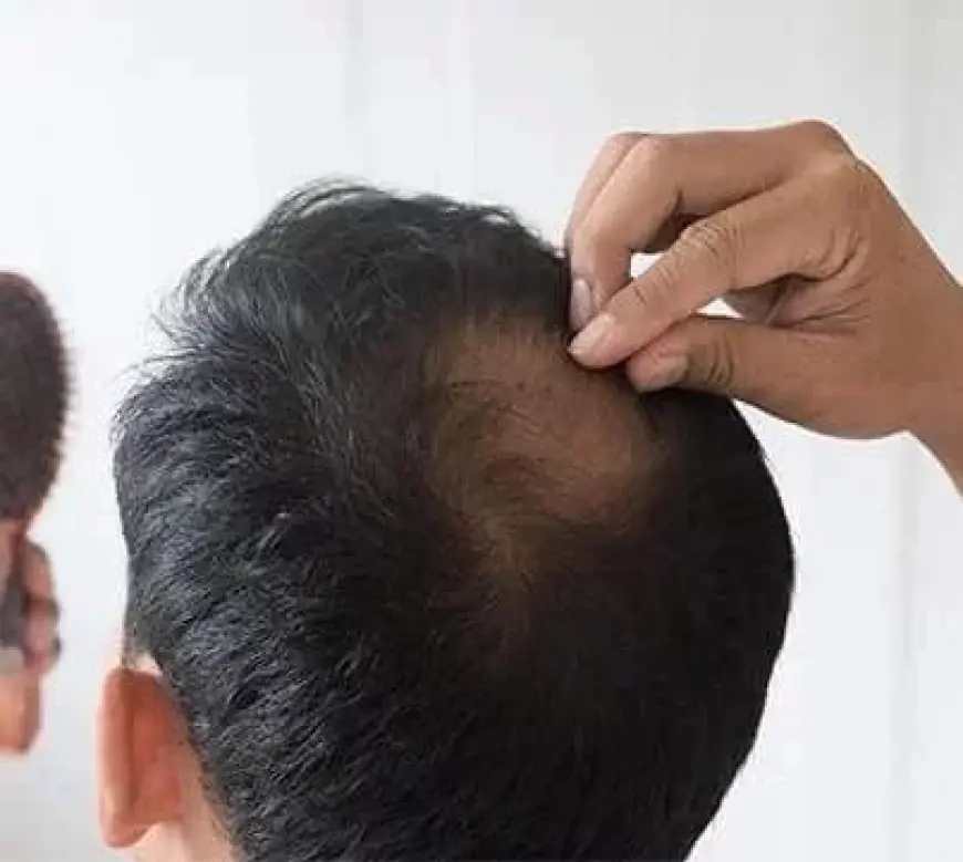 Is Finasteride for Hair Loss Safe for Long-Term Use?