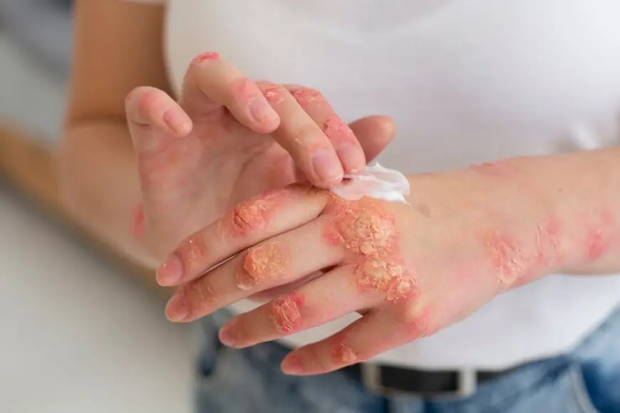 Individualized Care: How Homeopathy Treats Psoriasis.