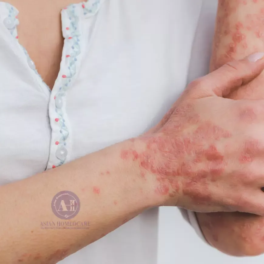 Individualized Care: How Homeopathy Treats Psoriasis.