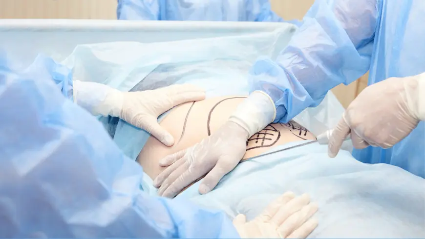 Explore Various Liposuction Techniques Offered in Dubai