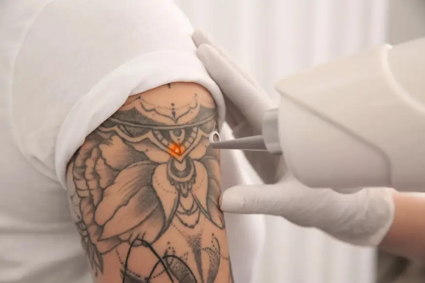 Why Laser Tattoo Removal in Dubai Is the Right Choice for Tattoo Regret