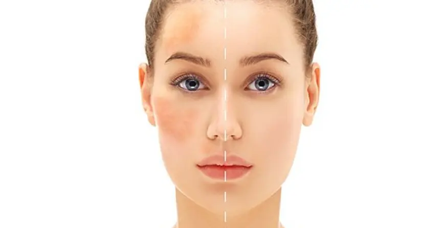 The Latest Innovations in Melasma Treatment for Dubai Patients