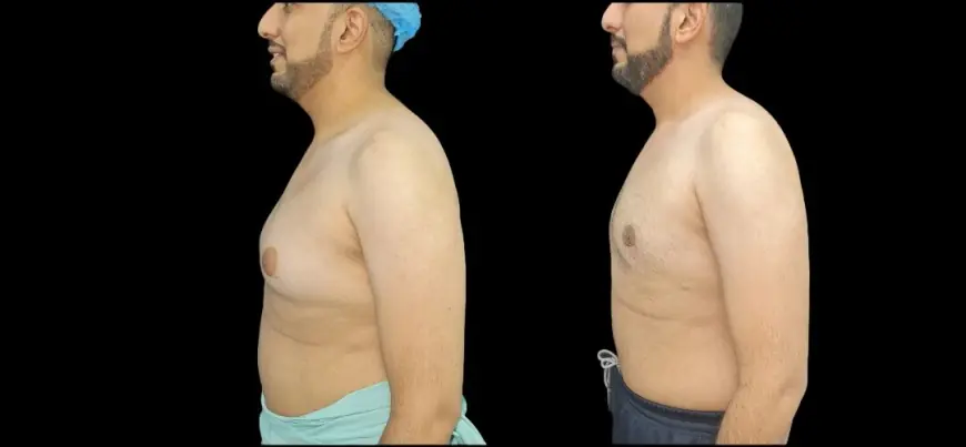 Best Doctors in Dubai: Enhancing Masculine Confidence Through Gynecomastia