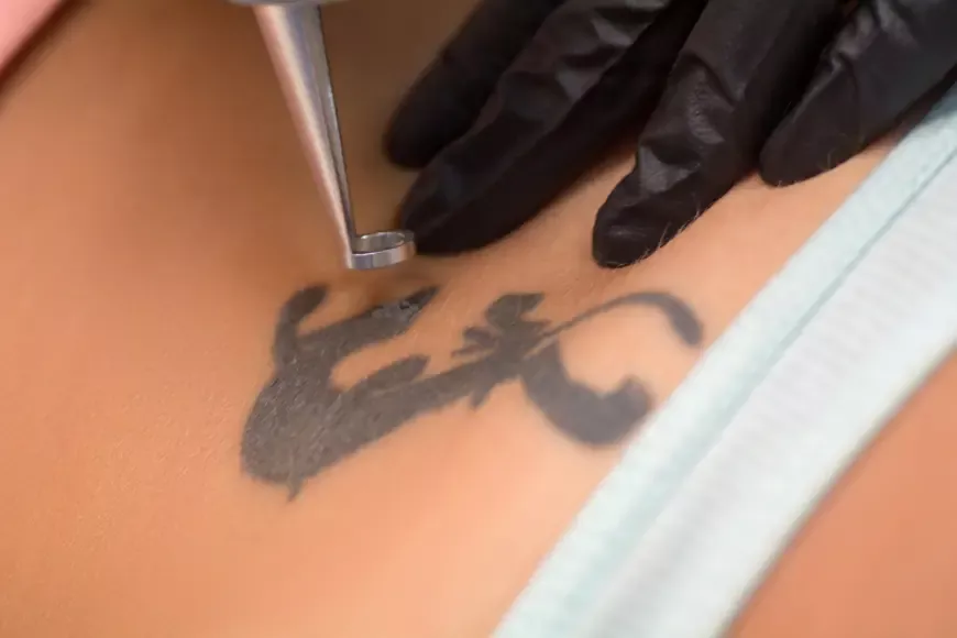 Your Best Option for Tattoo Removal: Laser Tattoo Removal in Dubai