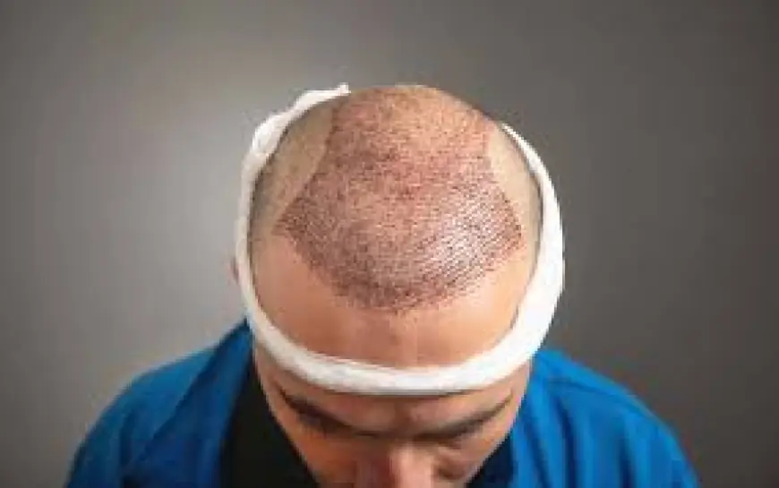 Hair Transplant Experts in Riyadh: Your Solution to Balding