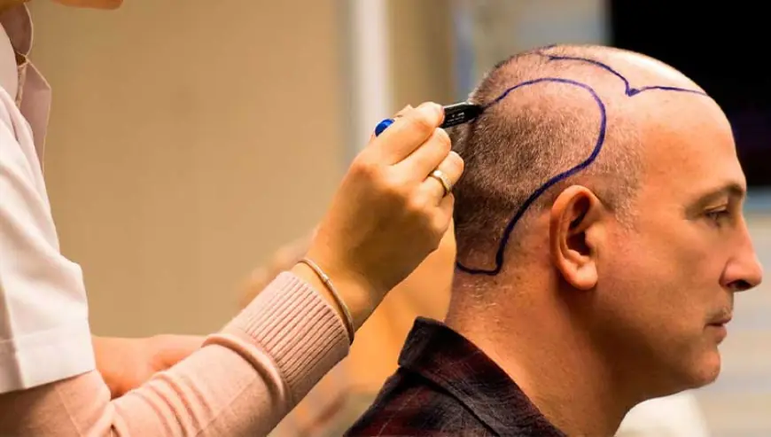 FUE vs. FUT: Which Hair Transplant Method is Right for You?