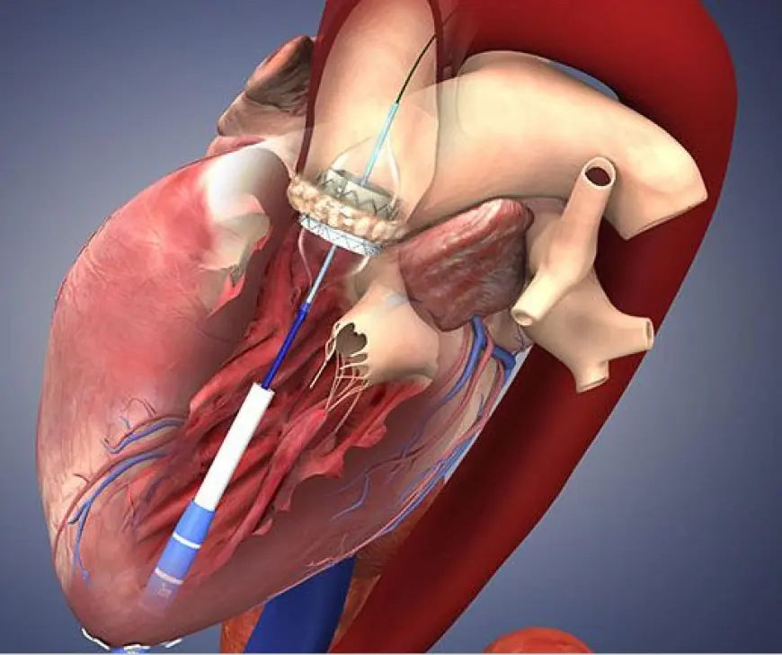 Arterial Catheters Market To See Stunning Growth by 2033