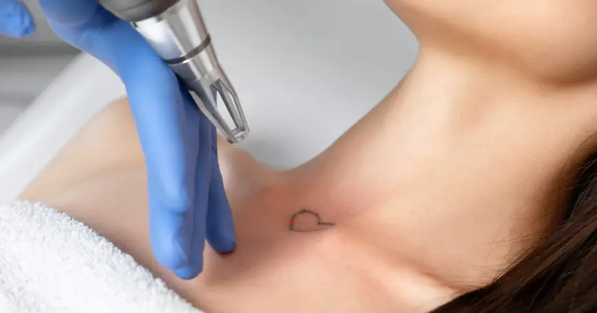 Erase Regret with Laser Tattoo Removal in Dubai