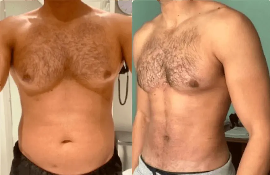 Affordable Treatments for Gynecomastia in Dubai