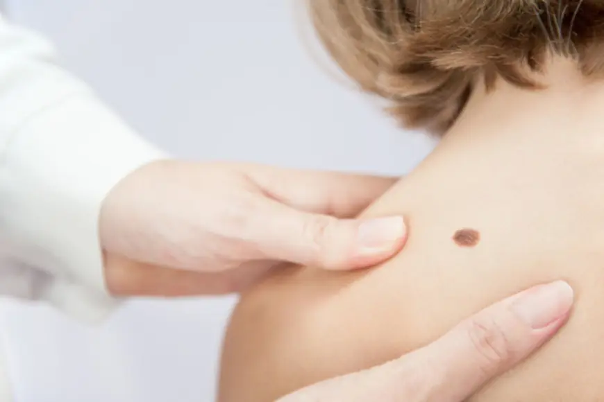 What Are the Best Methods for Birthmark Removal in Dubai?