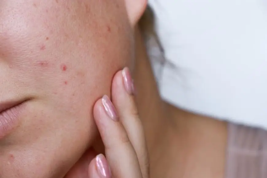 How to Use Acne Treatment Products for Maximum Effectiveness?