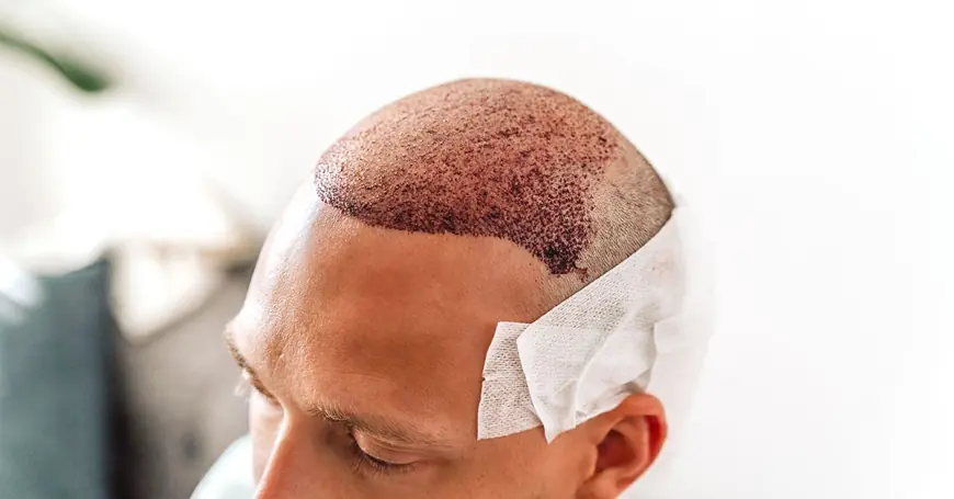 Say Goodbye to Baldness: Dubai Hair Transplants