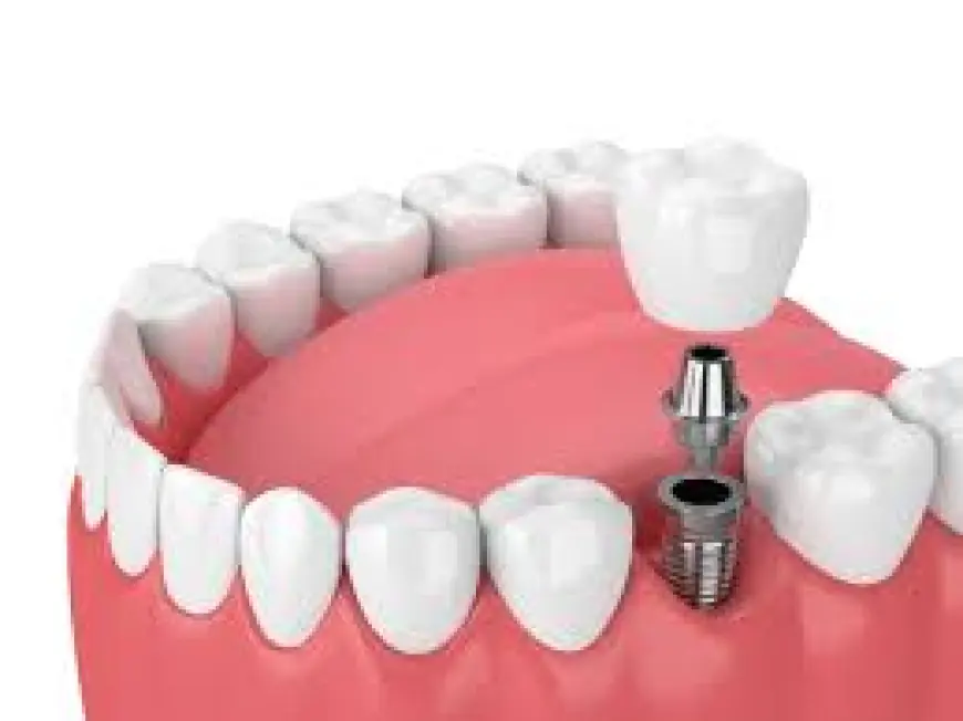 Top Questions to Ask Your Dentist Before Getting Dental Implants