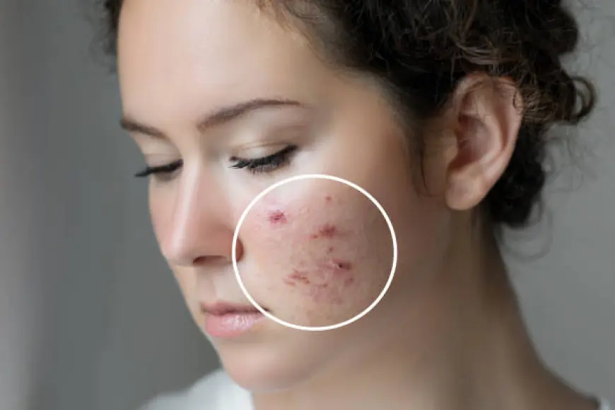 Transform Your Skin: Comprehensive Acne Scar Treatment in Islamabad