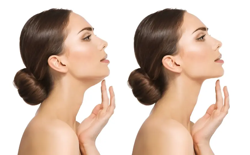 Effective Double Chin Treatments: What You Need to Know