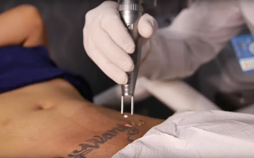 Your Skin, Your Rules: Laser Tattoo Removal in Dubai