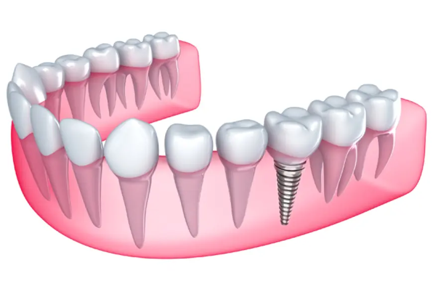 Is Dental Implants Treatment the Solution to Your Gaps?