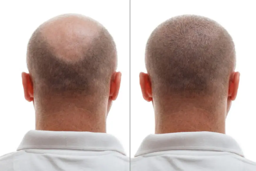 Hair Loss No More: Explore Dubai’s Best Hair Transplant Options