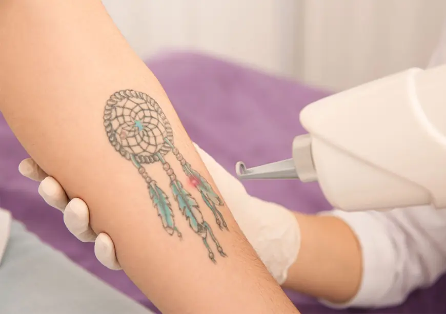 The Most Common Reasons People Choose to laser tattoo remove