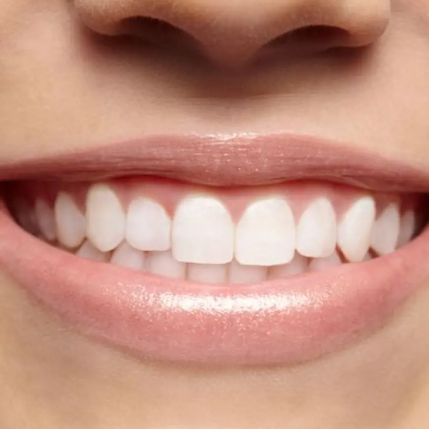 Is Teeth Whitening the Key to a Winning Smile?