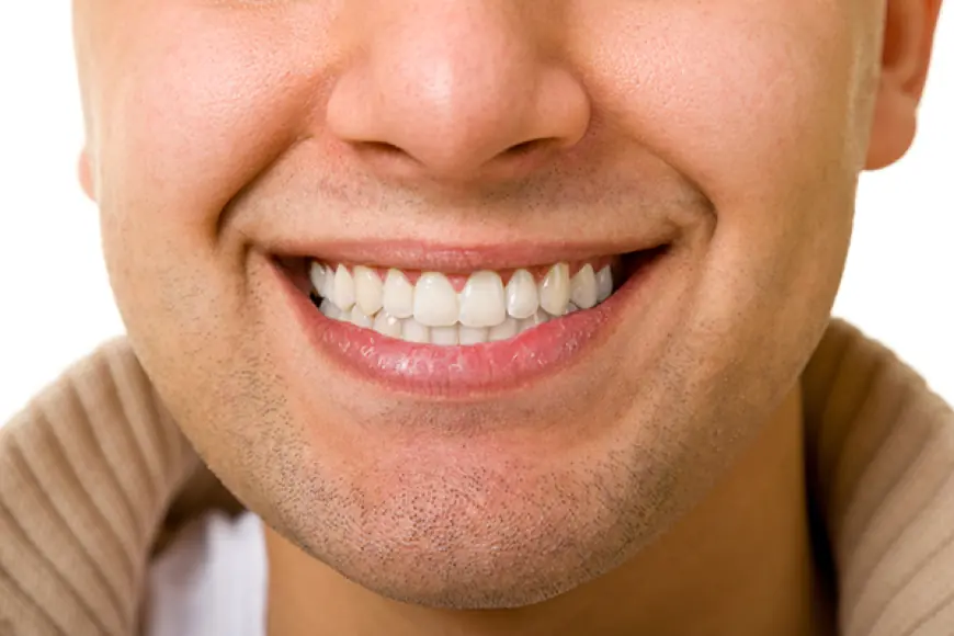 Is Composite Veneers Safe for Teeth?