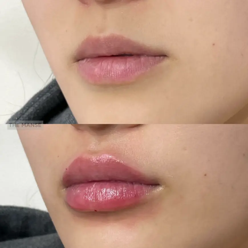 Everything You Need to Know About Lip Fillers