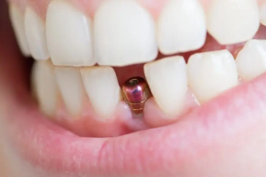 How Dental Implants Are Revolutionizing Tooth Replacement