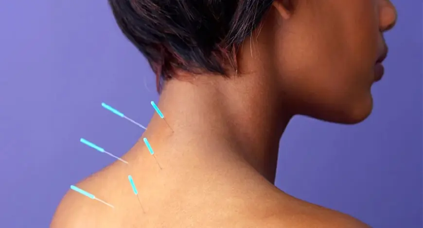 5 Common Myths About Acupuncture Debunked